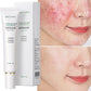 Acne Cream Facial