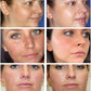 Whitening Freckles Cream Remove Melasma
